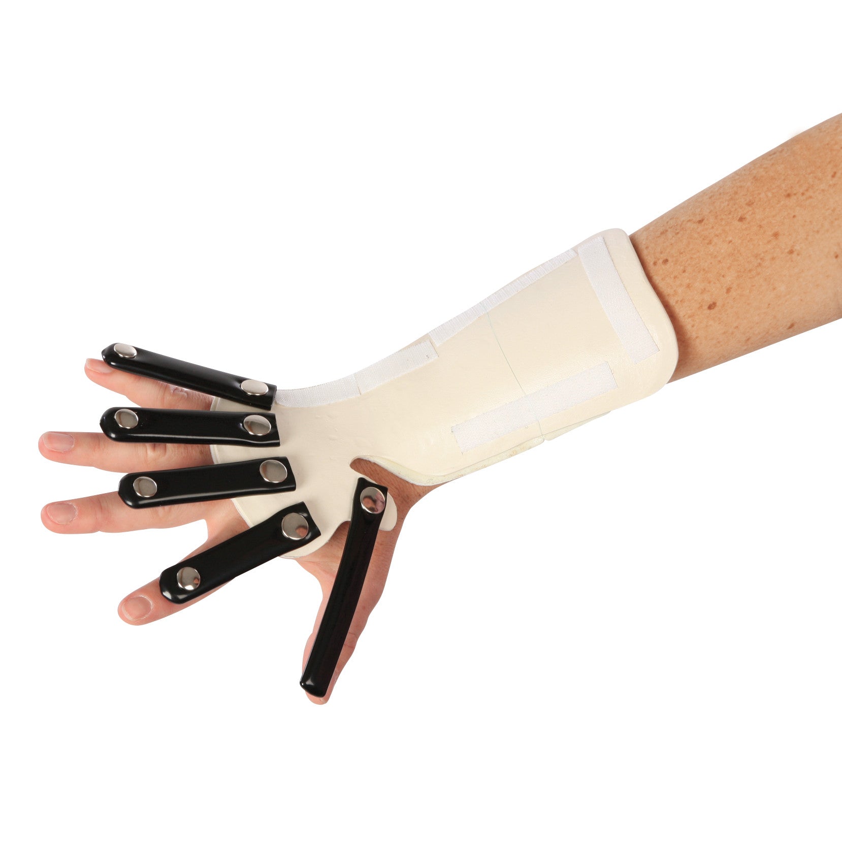 A person's arm is fitted with the AliMed Forearm-Based Radial Nerve Splint, featuring black metal supports and a beige brace.