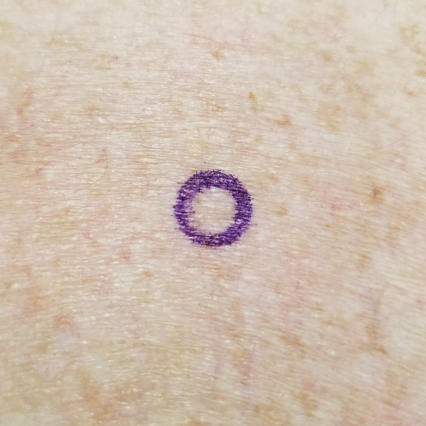 A purple circle on skin shows the Viscot Accumark Radiopaque Injection Site Markers, used for marking specific skin areas.