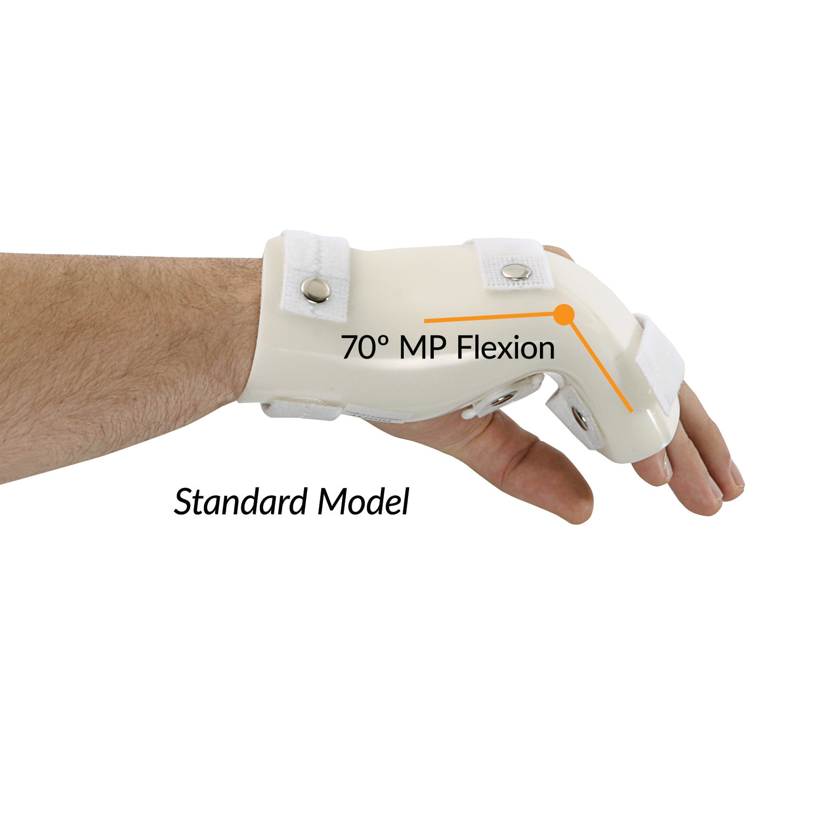 A forearm and hand wearing a G-Force Boxers Splint with MP Flexion at 70 degree, secured with straps